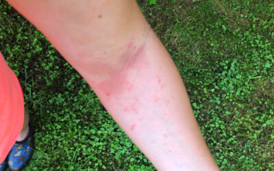 5 Natural Remedies for Poison Ivy Rashes